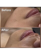 アールスサロン/フェイスシュガー 口まわり