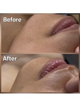 アールスサロン/フェイスシュガー 口まわり