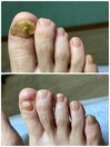 変形、肥厚爪［所沢/狭山ヶ丘］