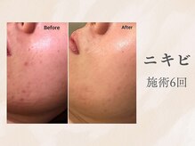 『ハーブピーリング×小顔マッサージ』セットになって血行促進◎