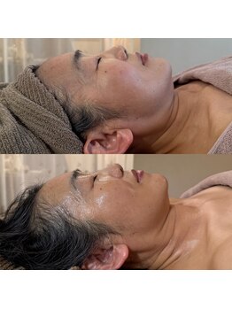 エステサロン マコ(MaCo)/60代・しわたるみ改善