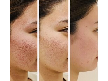 クリニカルエステ/イーズ パークプレイス大分店/20代 ピーリング3回