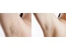 【学割U24】ワキ脱毛 ★女性 ¥2,500/男性 ¥3,500