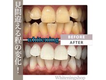 ホワイトニングショップ みなとみらい店の雰囲気（ゆったりリクライニングチェアでホワイトニング☆自分時間に♪）