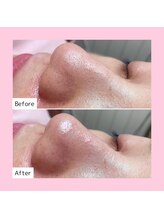 ホワイトラボ 梅田(White labo)/【施術例】ハイドロフェイシャル