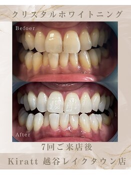 キラット 越谷レイクタウン店(Kiratt)/ビフォーアフター　5