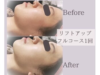 メロウ(Mello)/リフトアップ◇Before→after