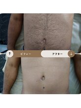 ジュゴン(Dugong)/お腹の脱毛（Before＆After）