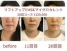 【1ヶ月以内の再来限定☆】リフトアップEMS&マイクロカレント 19,800円→