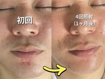 ミルダ(MIRUDA)/メンズ脱毛　ヒゲ脱毛／髭脱毛