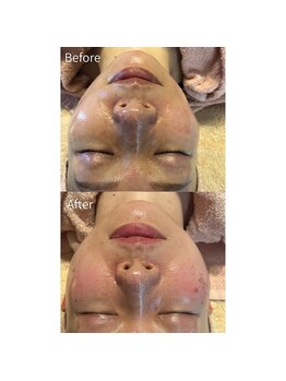 サロン アイプラス(salon i plus)/毛穴悩み