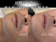 ダイヤ 名古屋中川区店(Daiya)の雰囲気（1回で減ったを実感、3回で印象変わる。脱毛で″清潔感″を！）