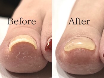 ジスタ(Gst)の写真/プレートなどはつけない巻き爪ジェルで爪のカーブを徐々に平らに整え、本来の自然なカーブに整えます☆