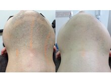 リムーブ(Re:move)の雰囲気（髭脱毛☆全男性の悩み青髭卒業！毎朝の自己処理不要で清潔肌へ！）