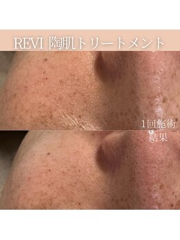 リフィール(Re:feel)/REVIハーブピーリングで毛穴ケア