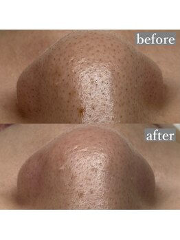 ライカブルー(RaicA BluE)/施術写真　before-after