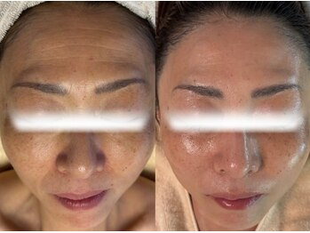 ルミア(LUMIA)/深いシワ/たるみ/ほうれい線改善