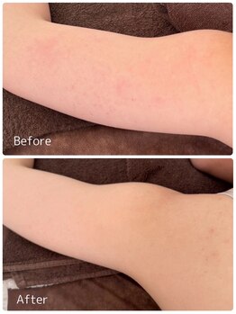 ククル(KUKULU)/二の腕ハーブ3回目♪(20代女性)