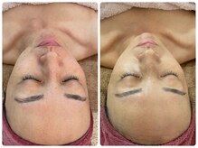 ミニマル(minimal)/REVIハーブピーリング