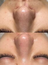 韓国肌管理室ハナ(hana)/究極肌管理【肌質改善/毛穴】