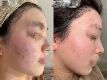 スターラッシュ(Star Lash)/肌改善コース