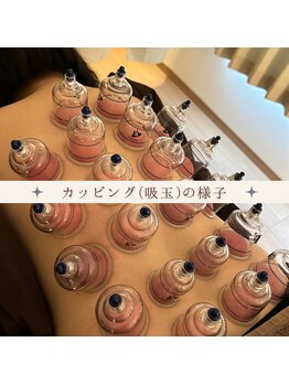 ナオ鍼灸院(Nao鍼灸院)/カッピングでデトックス♪