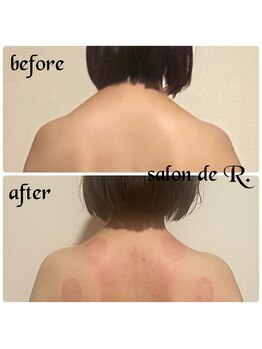 サロン ド アール(salon de R.)/【お背中骨氣・20代・施術効果】