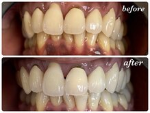 マカオン(machaon)/セルフホワイトニング