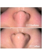 ミニョン(mignon)/さよなら！いちご鼻！