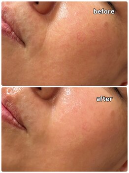 エアリ ネイル(Aeri Nail)/ハーブピーリング