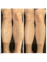 メンズ エステティック ヒーロー(men's esthetic HERO)/HERO　脚WAX