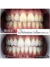 ホワイトニングサロン 京都烏丸店/ホワイトニング施術例