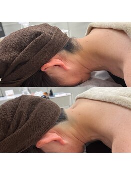 ミース 静岡駅前店/うなじ　ビフォーアフター