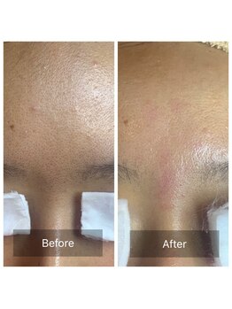 癒える(ielu)/毛穴エクストラクション