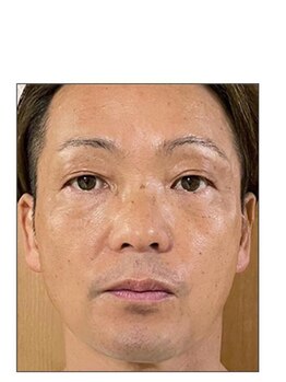 リベル 名古屋(Lebelle:)/ハーブピーリング専門名古屋