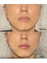 ビーメイクス(B・Makes)/プラズマ小顔矯正