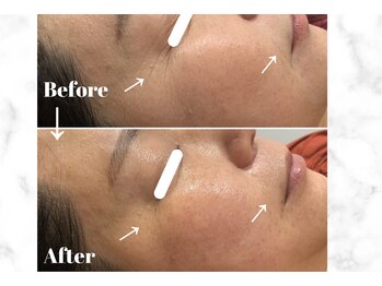 カラーリリー アンド ユン(Calla lily & yun)/大人気ヒト幹細胞コース