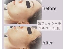 メロウ(Mello)/光フェイシャル◇Before→after