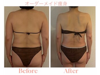 アティレ オオサカ(Attirer Osaka)/【50代】オーダーメイド痩身