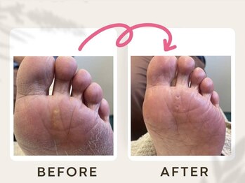 ドクターネイル爪革命 恵庭店/魚の目ケア