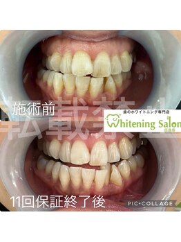 ホワイトニングサロン 広島店/【ホワイトニング11回照射】
