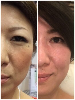 ツヤハダコガオ 千葉店/before⇒after【サーマリフト】