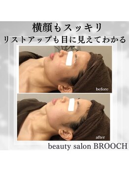 ブローチ 岡崎店(BROOCH)/究極小顔ケアBHF