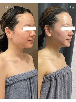 レクシア(LEXIA)/小顔ケア症例｜PRO LIFT 4回目