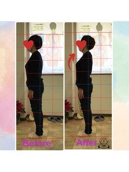 カイロプラクティック コダマ(KODAMA)/姿勢矯正ビフォーアフター