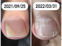 エスネイル(S Nail)/巻き爪ケア/巻き爪補正