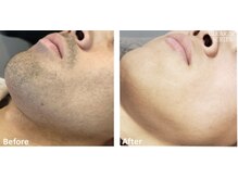 ララリア(LaLaLia)/ひげ　ビフォーアフター