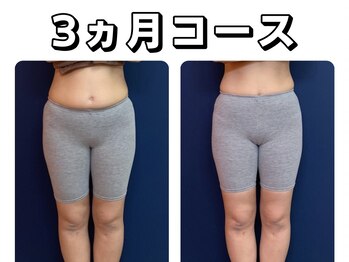 久留米スポーツ整骨院 整体院/エステ◆痩身インディバエステ