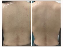 ミューベル(MYubelle)/【背中ケア】水光ピーリング