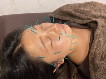 イゴ(IGO)の写真/《一人ひとりのお肌の状態に合わせた美容鍼》身体の辛い不調から美容まで鍼施術でお悩みを根本から改善◎